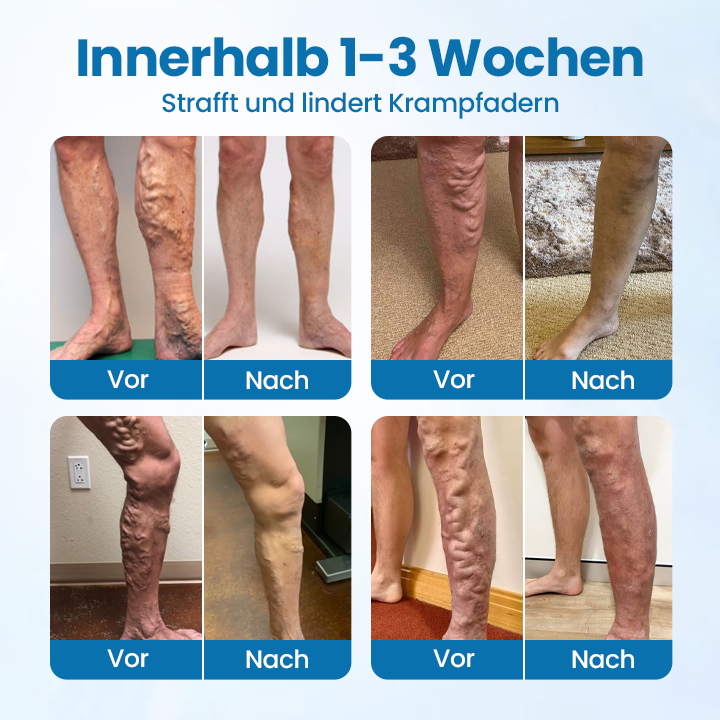 VeinGuard Herbal Spray – Clinically Proven to Diminish Varicose Veins in Just 7 Days