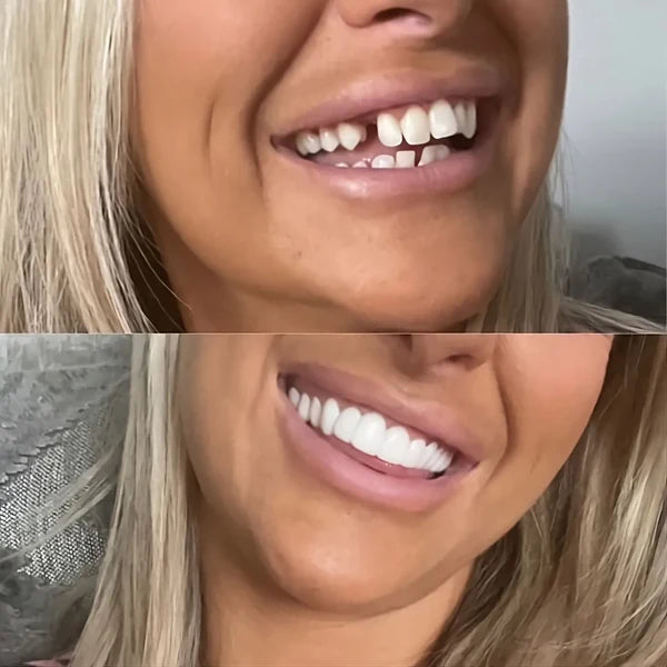 Tiktrove Clip-on Veneers