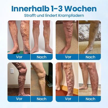 VeinGuard Herbal Spray – Clinically Proven to Diminish Varicose Veins in Just 7 Days