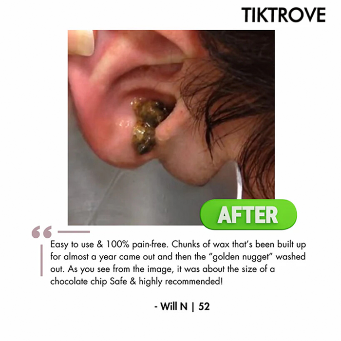 Tiktrove Electric Ear Wax Removal Kit