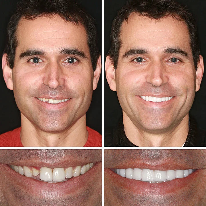 Medical Full Denture with Strong Suctiond🦷Obtain American Dental Association (ADA) Certification