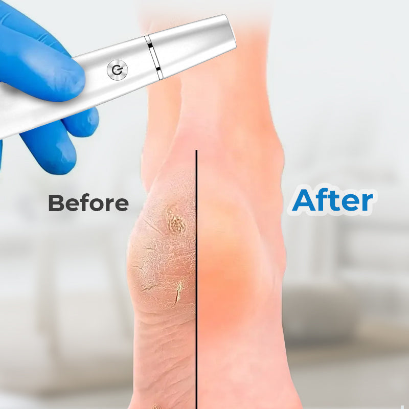 🔥Electric Feet Callus Remover⚡